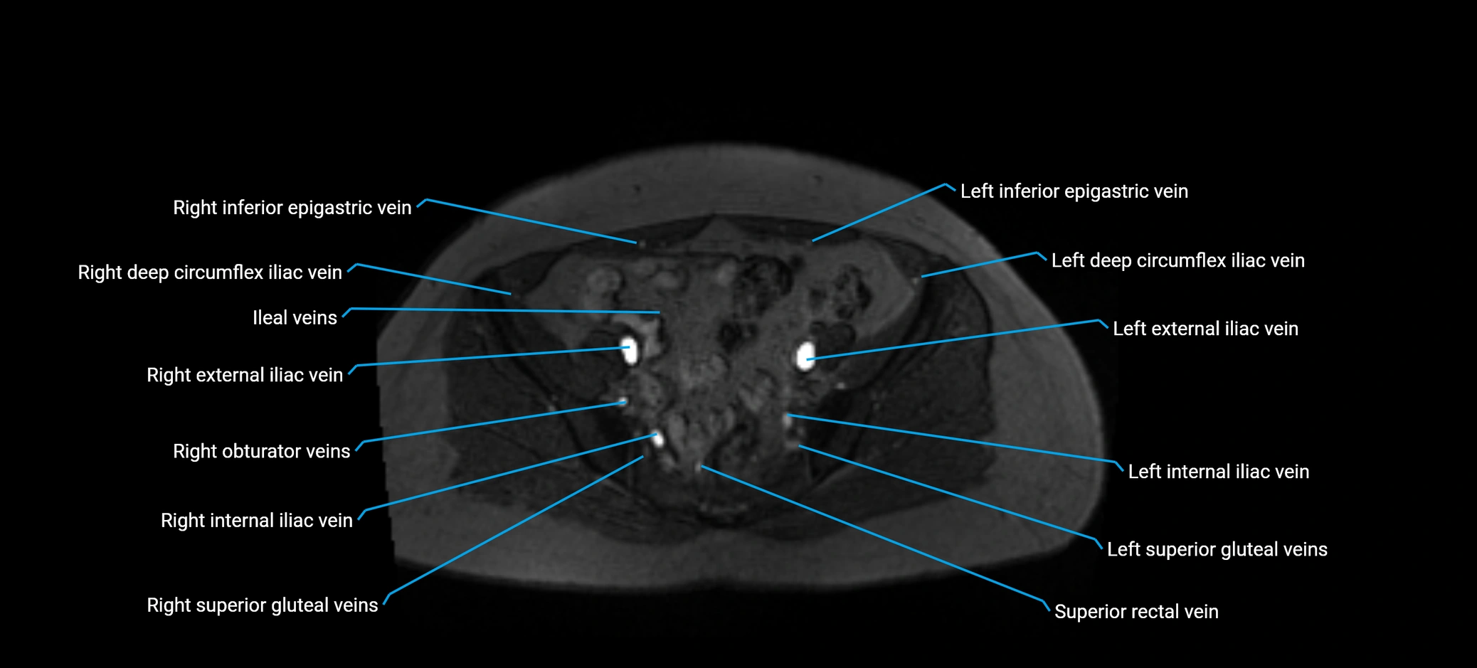 MRV abdomen pelvis & lower limb axial cross sectional anatomy labelled MRI image 146 (1).webp